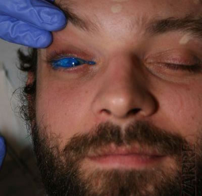 In the nineteenth century eyeball tattooing was used as a cosmetic 